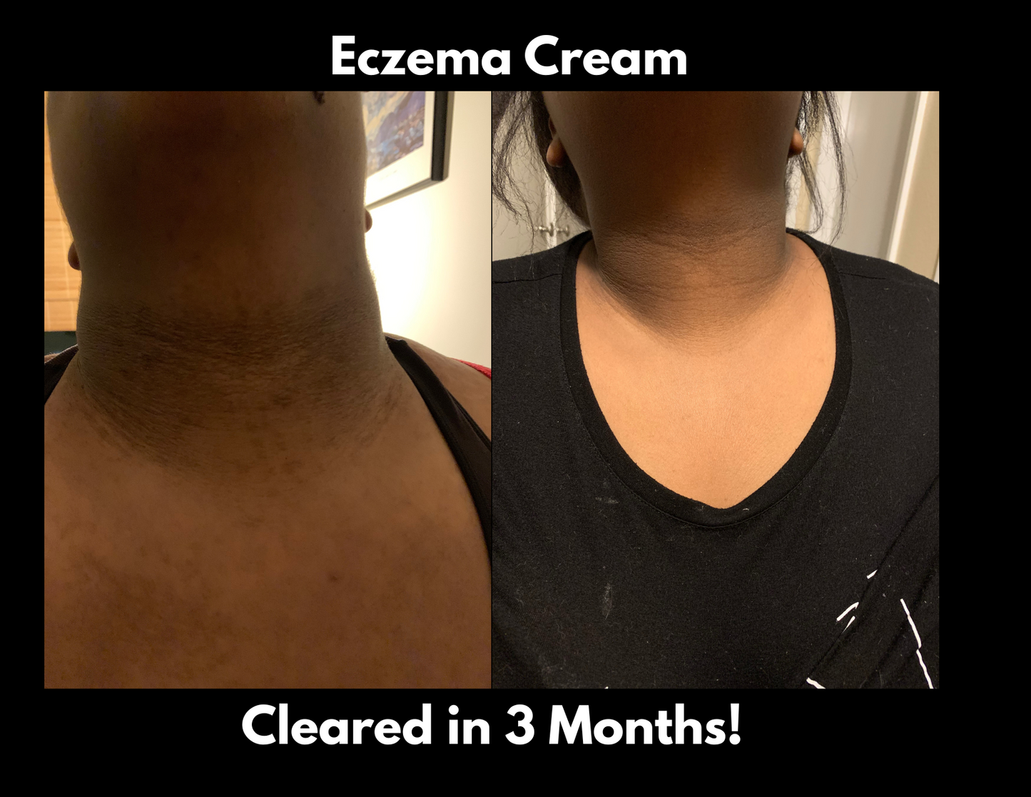 Eczema Cream-Compassionate Care For Flawless Skin